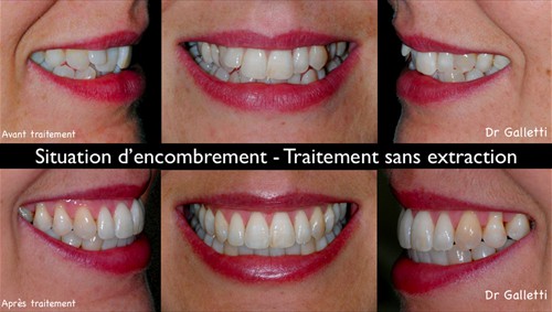 Photos Avant / Après Traitement - Cabinet Orthodontie Paris 15è
